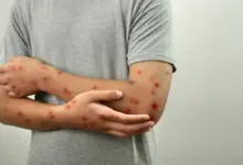 Casos de mpox aumentam no Brasil em 2026